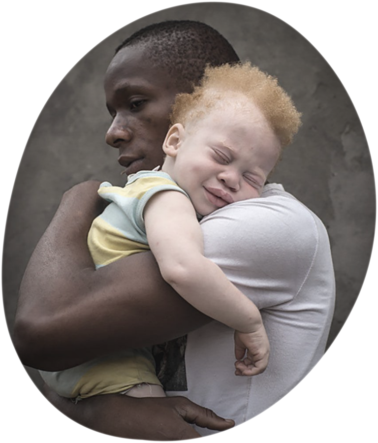 about-albinism-albinism-foundation-of-zambia-afz